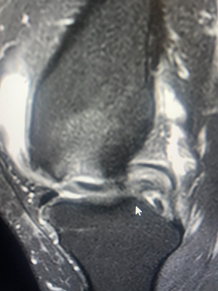 MRI scan of Osteochondritis Dissecans (OCD) lesion in the knee, highlighting the critical need for early medical imaging by Dr Prashant Sankaye, MRI Expert.