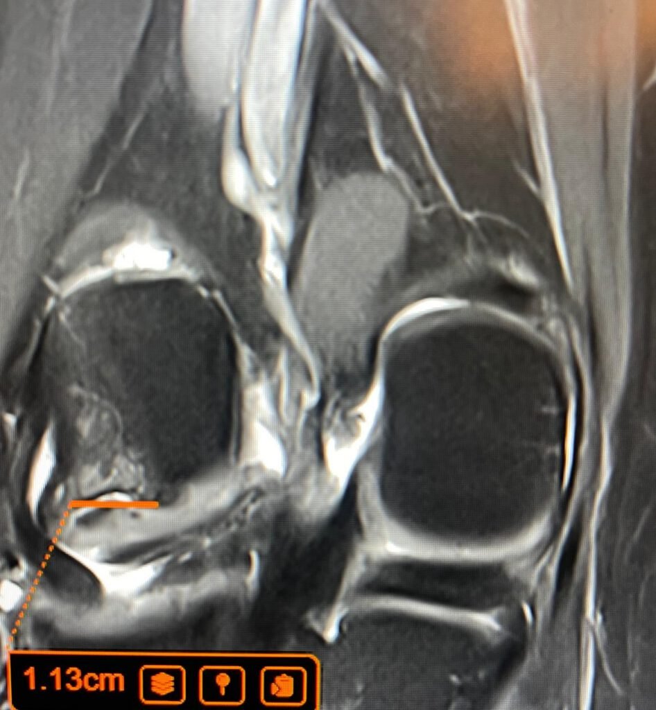 Coronal knee MRI scan showing 1.13cm OCD cartilage defect medial femoral condyle - private knee MRI scan London by Dr Prashant Sankaye FRCR LSRI Harley Street NHS waiting list alternative
