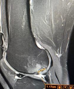 Knee MRI Scan Explained: A Complete # 1 Patient Guide by Dr Prashant Sankaye