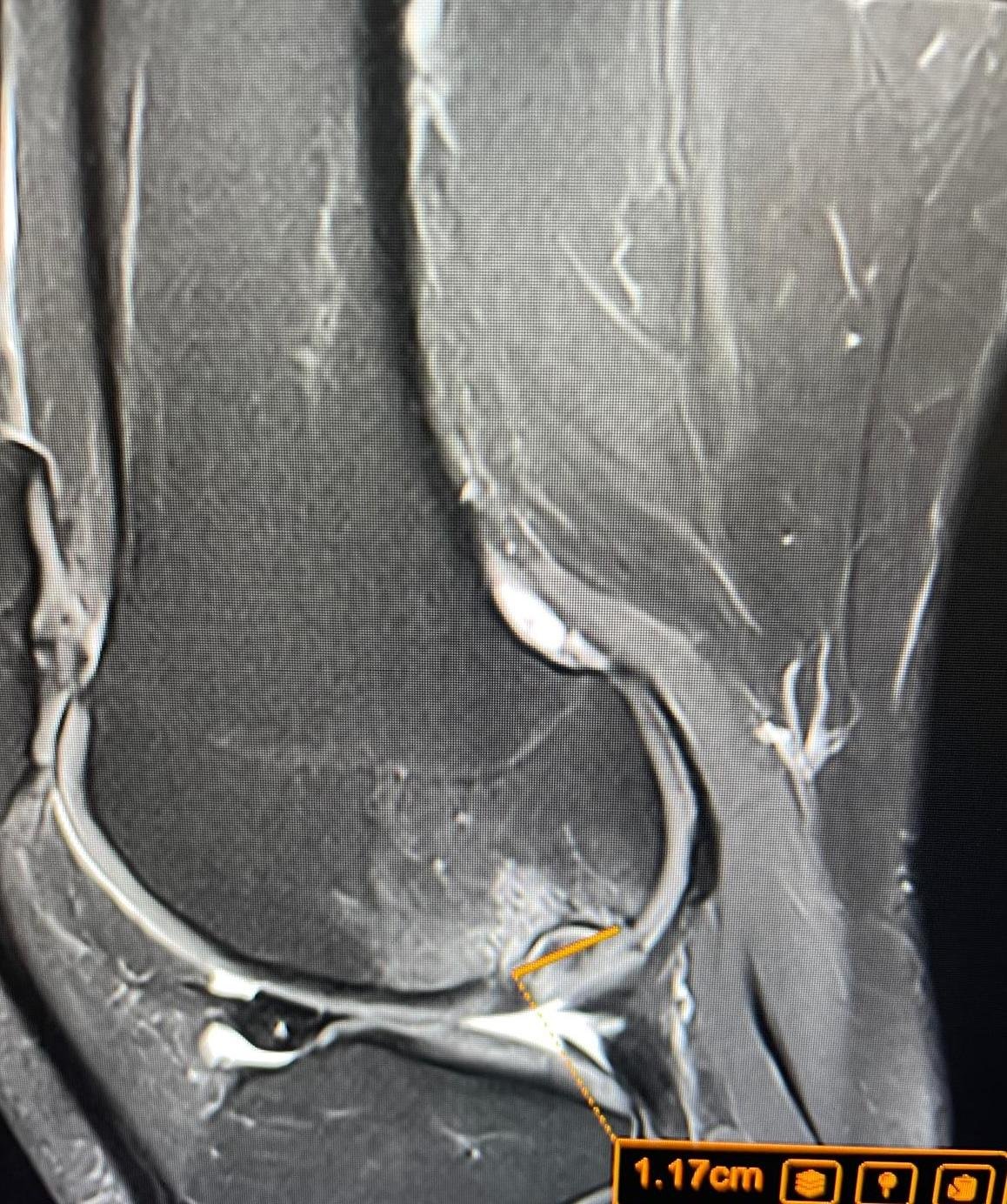 Knee MRI Scan Explained: A Complete # 1 Patient Guide by Dr Prashant Sankaye