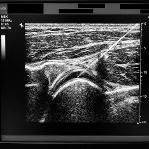 Why Ultrasound-Guided Injections Are the Gold Standard for Joint Pain