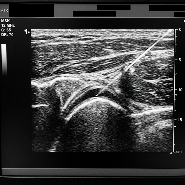 Why Ultrasound-Guided Injections Are the Gold Standard for Joint Pain