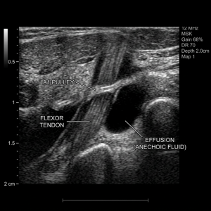 Trigger Finger Treatment London: The Ultrasound-Guided Gold Standard