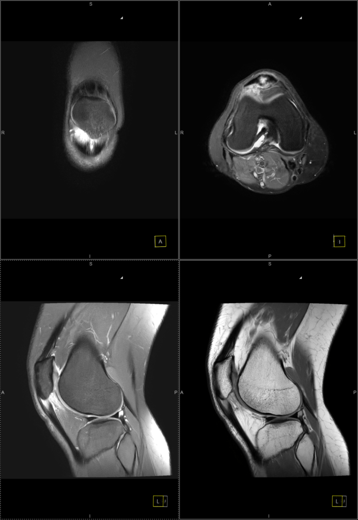 Two Years of “Patellar Tendonitis” – When Anterior Knee Pain Is Really Severe Patellar Tendinopathy and Hoffa’s Fat Pad Impingement