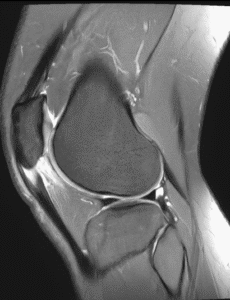 Two Years of “Patellar Tendonitis” – When Anterior Knee Pain Is Really Severe Patellar Tendinopathy and Hoffa’s Fat Pad Impingement