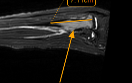Delayed Diagnosis Elbow Tumour: One Year of Elbow Pain by Dr Prashant Sankaye