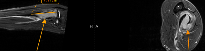 Delayed Diagnosis Elbow Tumour: One Year of Elbow Pain