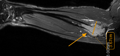 MRI of the elbow demonstrating a soft tissue mass identified by Dr Prashant Sankaye FRCR after a 12-month diagnostic delay. Reported at LSRI.