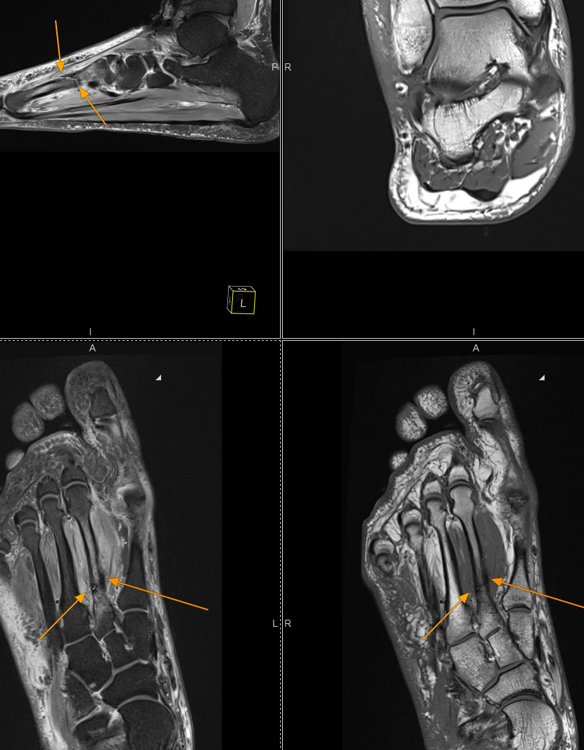 Delayed Diagnosis of Stress Fractures: The Hidden Epidemic of Unexplained Pain