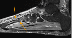 Delayed Diagnosis of Stress Fractures: The Hidden Epidemic of Unexplained Pain