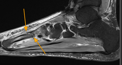 Delayed Diagnosis of Stress Fractures: The Hidden Epidemic of Unexplained Pain