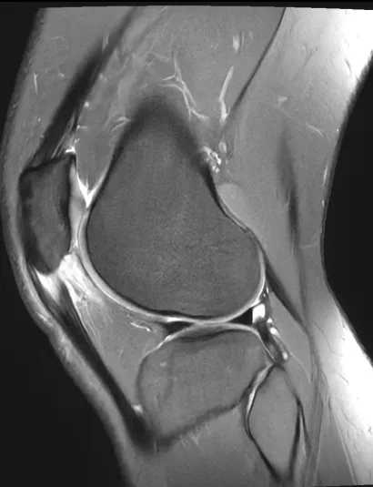 Two Years of “Patellar Tendonitis” – When Anterior Knee Pain Is Really Severe Patellar Tendinopathy and Hoffa’s Fat Pad Impingement