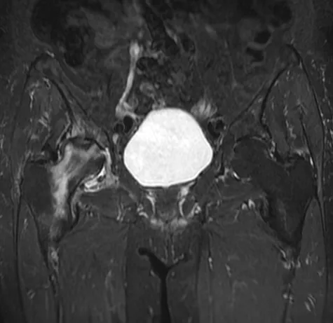 7 Best Avascular Necrosis Hip Exercises for Safe Rehab