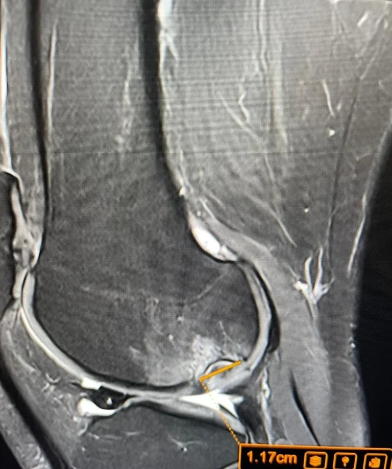 Knee MRI Scan Explained: A Patient Guide by Dr Prashant Sankaye