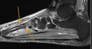 Delayed Diagnosis of Stress Fractures: The Hidden Epidemic of Unexplained Pain