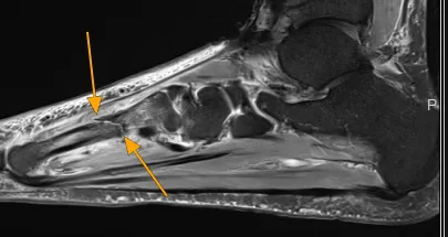 Delayed Diagnosis of Stress Fractures: The Hidden Epidemic of Unexplained Pain