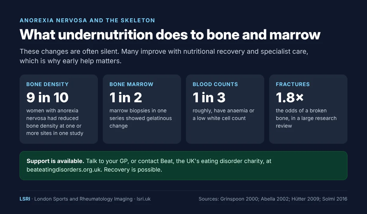 Gelatinous Bone Marrow Transformation in Anorexia Nervosa: What MRI Shows and Why It Matters 3 Effects of anorexia nervosa on the skeleton: reduced bone density, gelatinous marrow change, low blood counts and higher fracture risk, with a signpost to Beat. From an LSRI guide reviewed by Dr Prashant Sankaye, Consultant MSK Radiologist