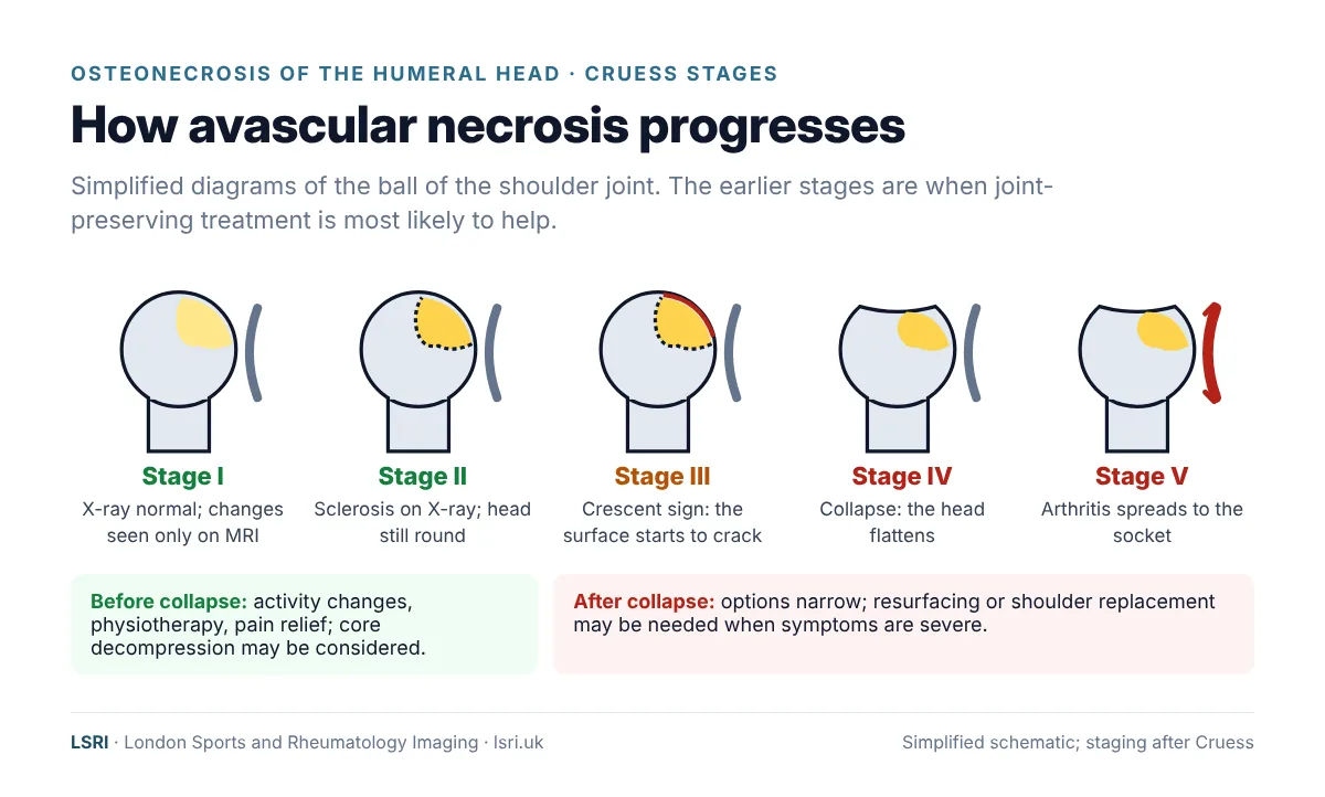 Diagram of the five Cruess stages of humeral head avascular necrosis, from stage I with a normal X-ray and MRI changes only to stage V with arthritis spreading to the socket. LSRI guide reviewed by Dr Prashant Sankaye, Consultant MSK Radiologist
