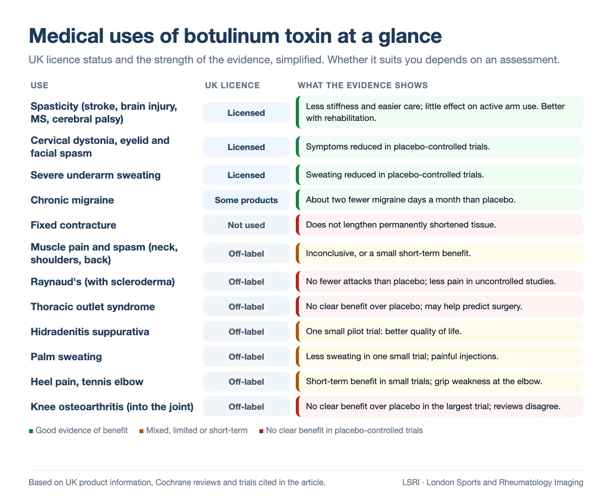 Table of medical uses of botulinum toxin with UK licence status and strength of evidence: spasticity, dystonia, underarm sweating and chronic migraine (licensed); muscle pain, Raynaud's, thoracic outlet syndrome, hidradenitis suppurativa, palm sweating, heel pain, tennis elbow and knee osteoarthritis (off-label)