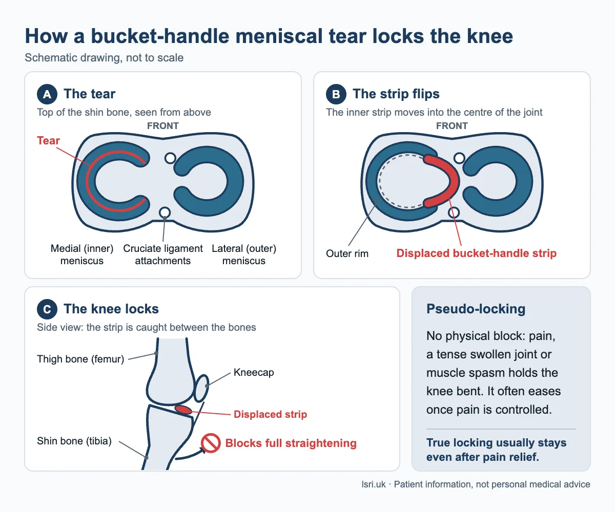 Diagram of a locked knee meniscus tear: a bucket-handle tear whose inner strip flips into the centre of the knee and blocks it from straightening