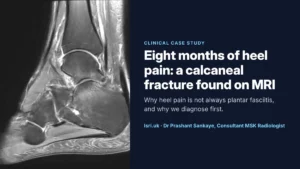 Eight Months of Heel Pain: A Calcaneal Fracture Found on MRI, and Why We Diagnose First