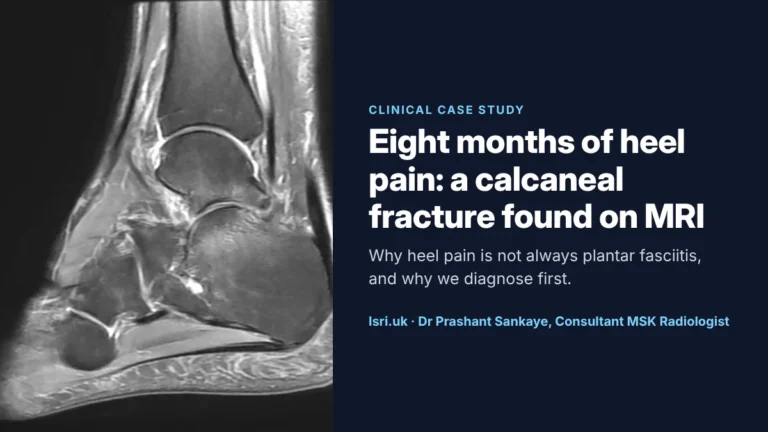 Eight Months of Heel Pain: A Calcaneal Fracture Found on MRI, and Why We Diagnose First