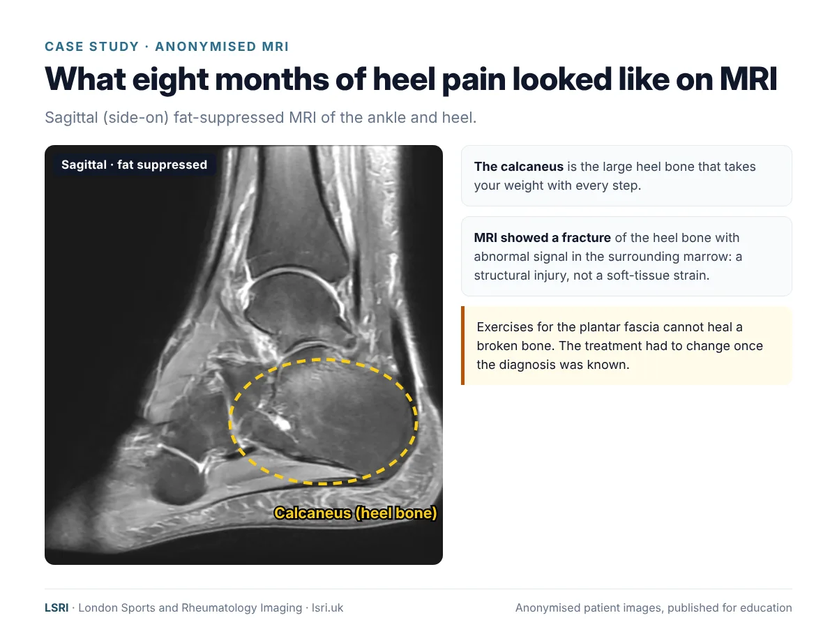 Eight Months of Heel Pain: A Calcaneal Fracture Found on MRI, and Why We Diagnose First 1 Anonymised sagittal fat-suppressed MRI of the ankle and heel with the calcaneus (heel bone) outlined. Anonymised case from LSRI, reviewed by Dr Prashant Sankaye, Consultant MSK Radiologist