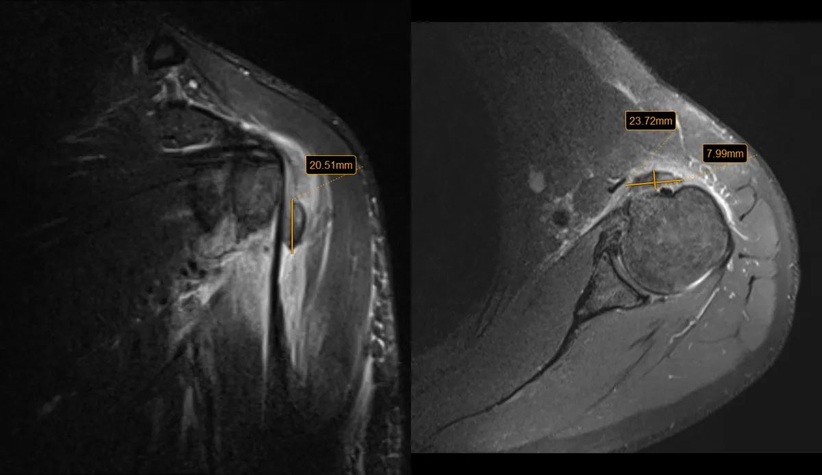 Sudden, Severe Shoulder Pain? Acute Calcific Tendinitis Explained 3 Shoulder MRI before barbotage, front-on and top-down views, showing a dark calcium deposit in the rotator cuff measured at about 2 cm long