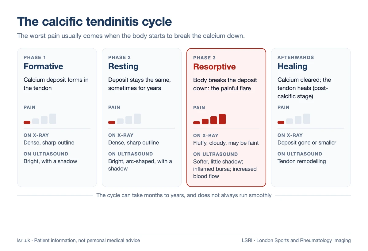 Sudden, Severe Shoulder Pain? Acute Calcific Tendinitis Explained 1 The calcific tendinitis cycle (formative, resting and resorptive phases, then healing in the post-calcific stage) with pain levels and how the calcium deposit looks on X-ray and ultrasound at each point