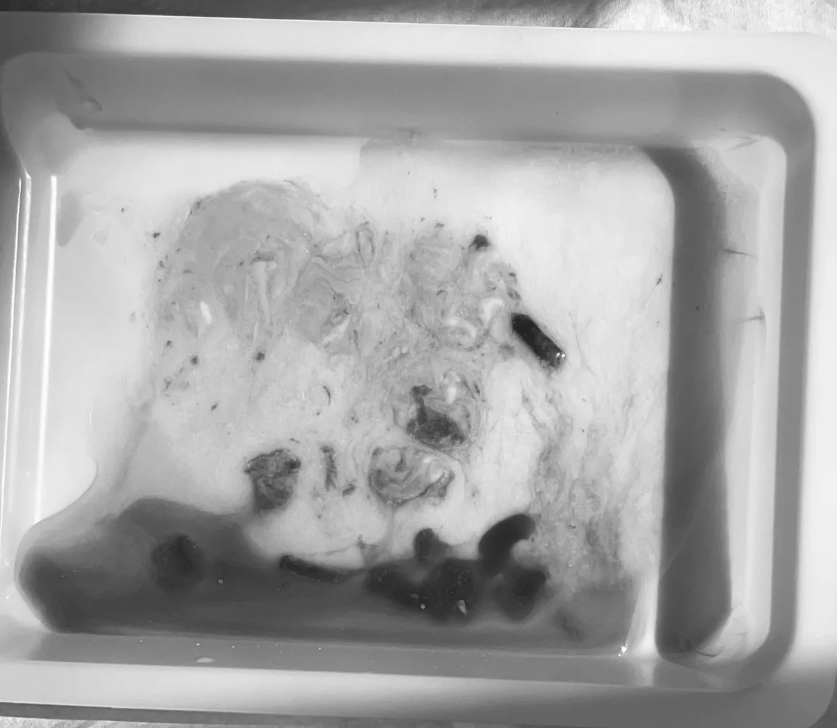 Sudden, Severe Shoulder Pain? Acute Calcific Tendinitis Explained 4 Chalky calcium washed out of a shoulder tendon during ultrasound-guided barbotage at LSRI, collected in a tray