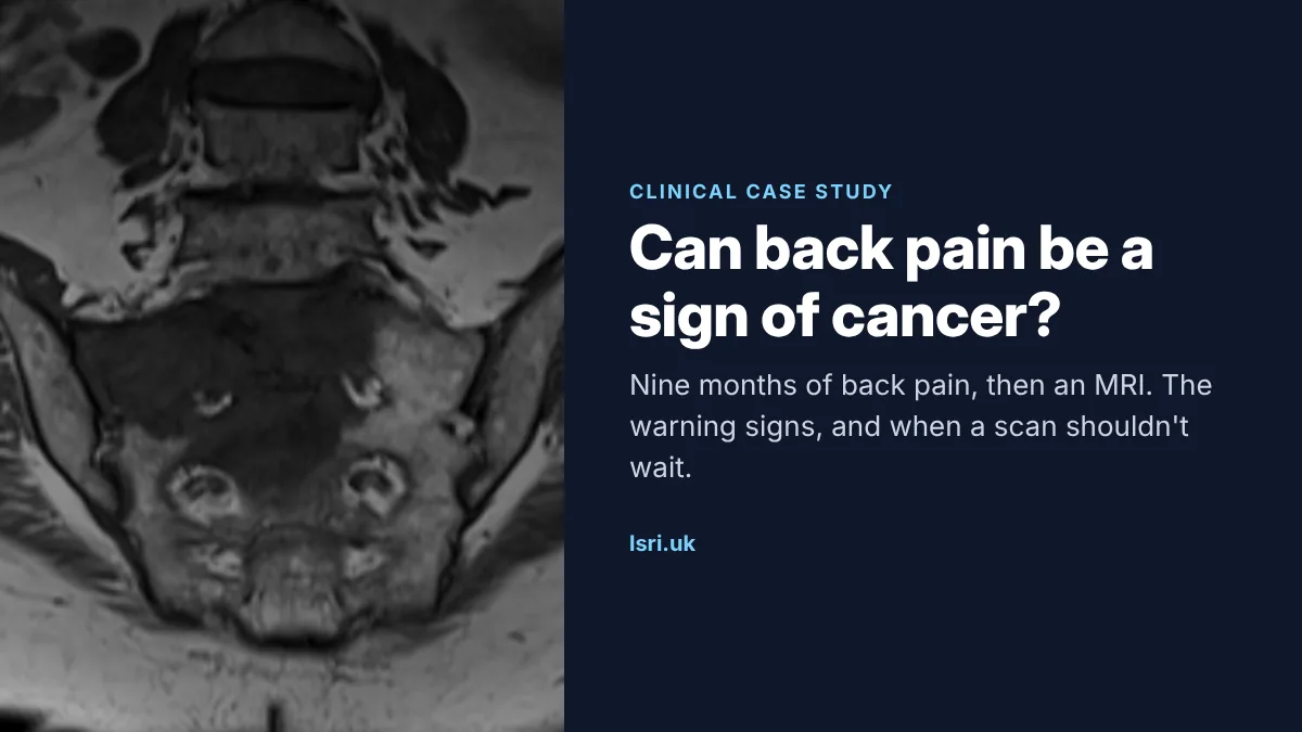 Can Back Pain Be a Sign of Cancer? A Case of Nine Months of Back Pain