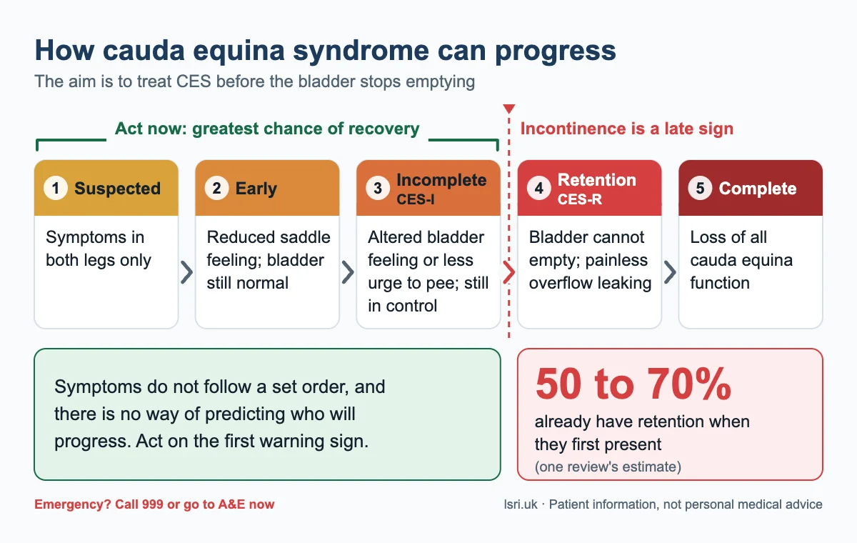 Cauda Equina Syndrome: Warning Signs and Why Hours Matter 3 Pathway of cauda equina syndrome stages from suspected and early, through incomplete CES, to retention and complete CES, showing action is needed before retention