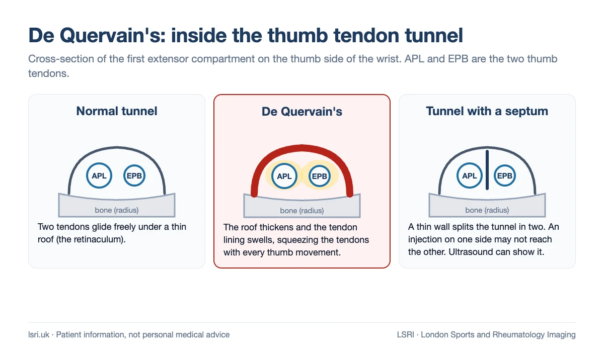 Cross-section diagram of the first extensor compartment of the wrist: a normal tunnel, the thickened tunnel and swollen tendon lining of De Quervain's tenosynovitis, and a tunnel divided by a septum