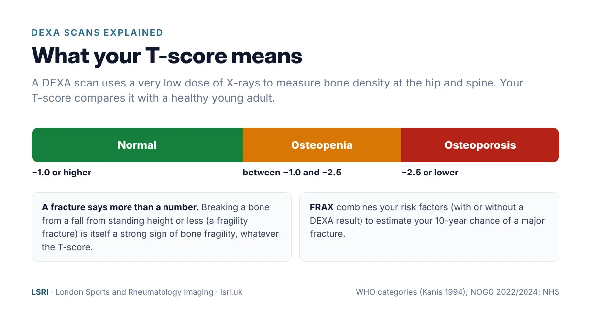 Sacral Insufficiency Fracture: A Hidden Cause of Back and Buttock Pain, and What It Says About Your Bones 3 DEXA T-score scale: normal at minus 1 or higher, osteopenia between minus 1 and minus 2.5, osteoporosis at minus 2.5 or lower. From an LSRI guide reviewed by Dr Prashant Sankaye, Consultant MSK Radiologist