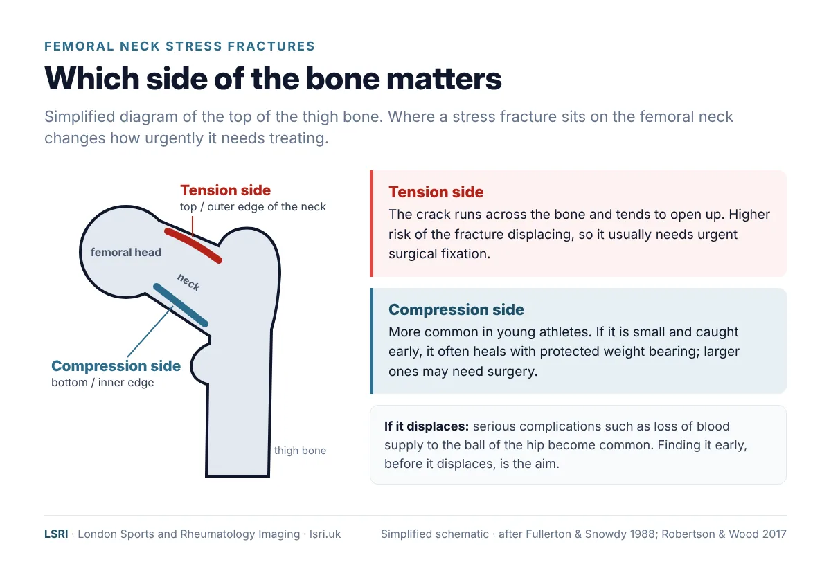 Hip Pain That Won't Settle: Stress Fractures of the Hip and Why MRI Matters 3 Diagram of the top of the thigh bone showing the tension side (top edge) and compression side (bottom edge) of the femoral neck and why it matters for treatment. From an LSRI guide reviewed by Dr Prashant Sankaye, Consultant MSK Radiologist