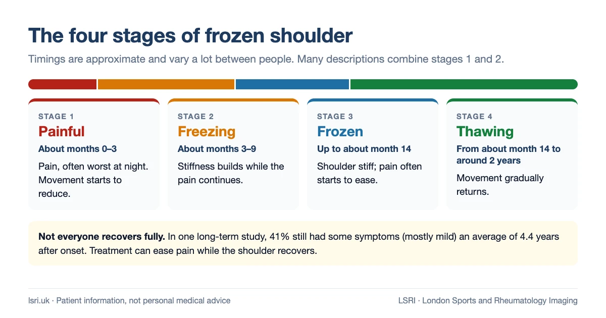 The four stages of frozen shoulder with approximate timings: painful, freezing, frozen and thawing