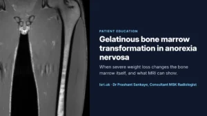 Gelatinous Bone Marrow Transformation in Anorexia Nervosa: What MRI Shows and Why It Matters