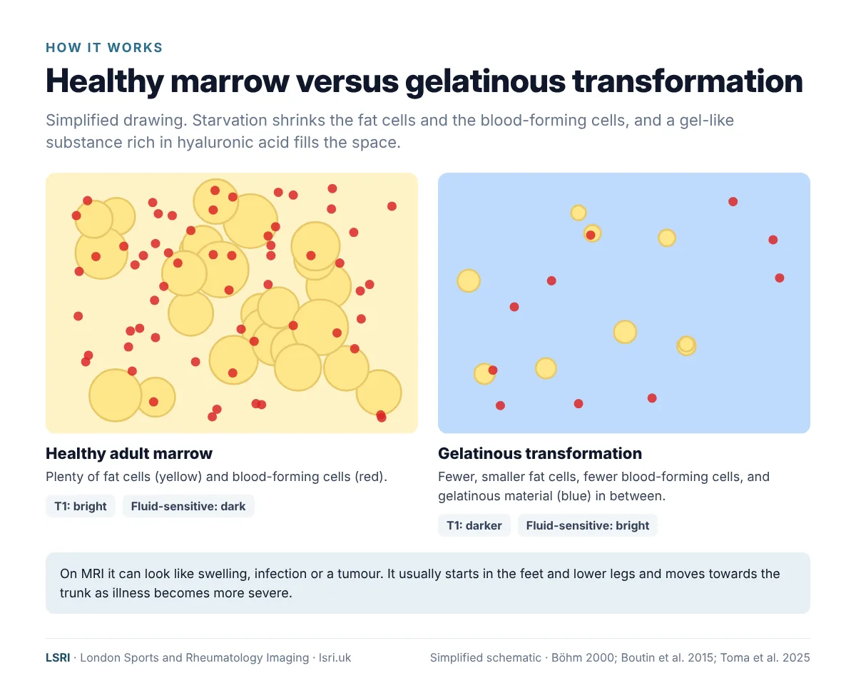Gelatinous Bone Marrow Transformation in Anorexia Nervosa: What MRI Shows and Why It Matters 2 Simplified diagram comparing healthy adult bone marrow with gelatinous transformation, and how each looks on T1 and fluid-sensitive MRI. From an LSRI guide reviewed by Dr Prashant Sankaye, Consultant MSK Radiologist