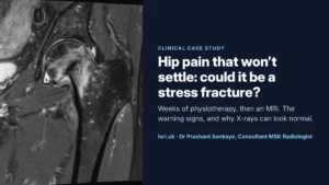 Hip Pain That Won’t Settle: Stress Fractures of the Hip and Why MRI Matters