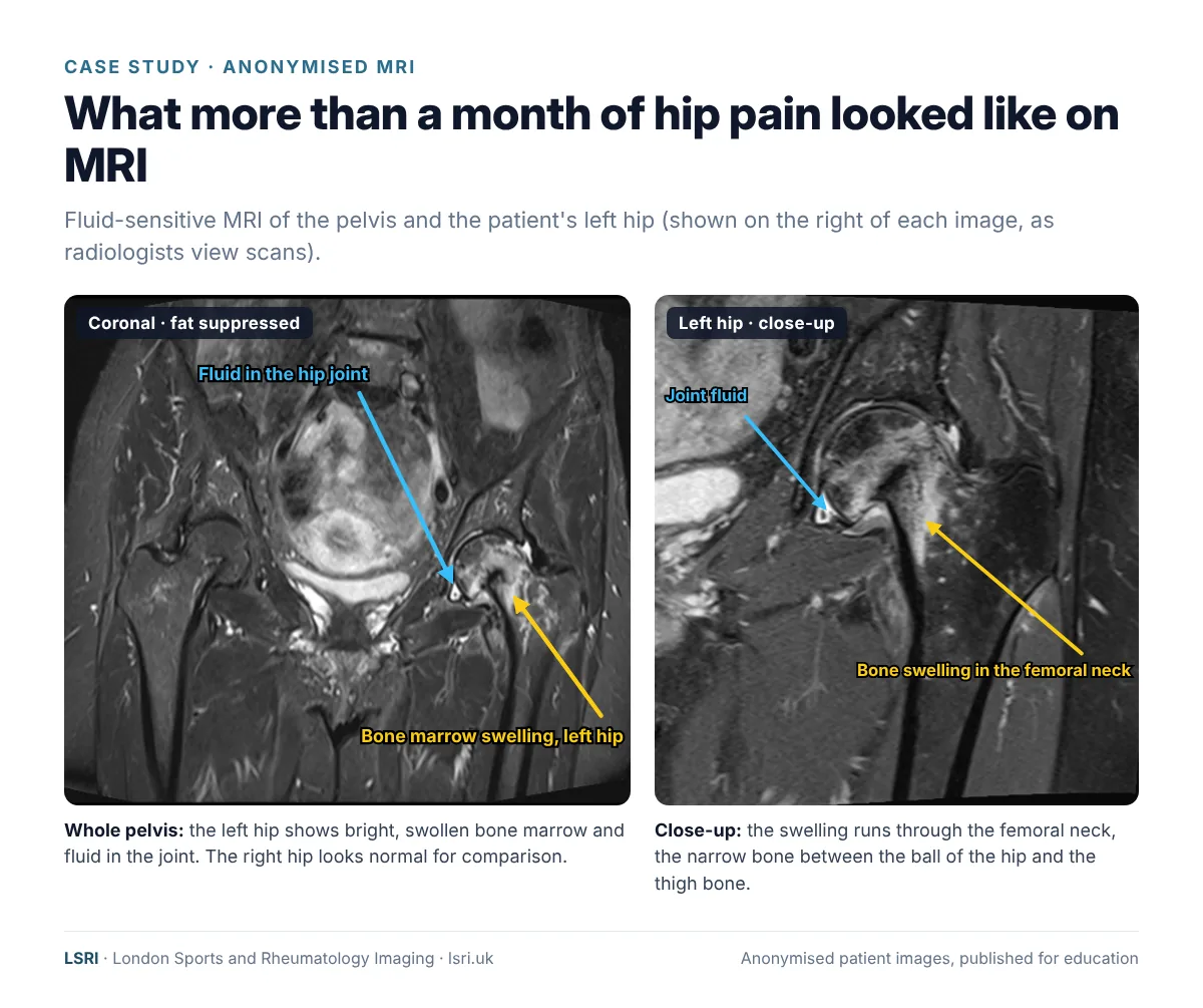 Hip Pain That Won't Settle: Stress Fractures of the Hip and Why MRI Matters 1 Anonymised coronal fat-suppressed MRI of the pelvis and a close-up of the left hip, showing bone marrow swelling in the femoral neck and fluid in the hip joint. Anonymised case from LSRI, reviewed by Dr Prashant Sankaye, Consultant MSK Radiologist