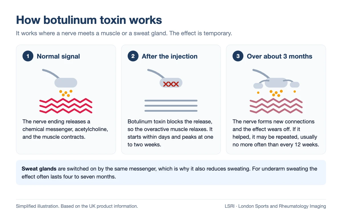 Diagram of how botulinum toxin works: normally the nerve ending releases acetylcholine and the muscle contracts; after the injection the release is blocked and the muscle relaxes; over about three months new nerve connections form and the effect wears off