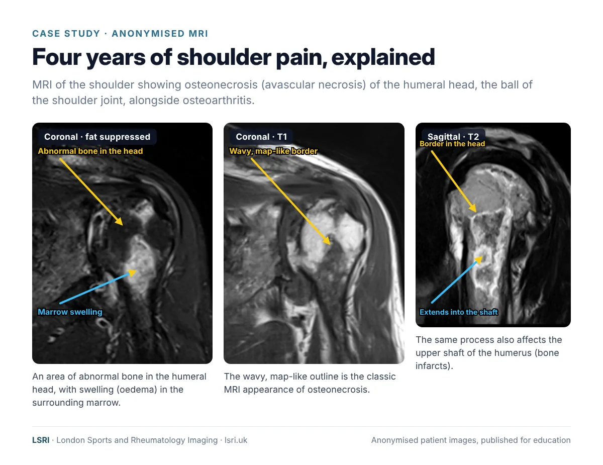 Anonymised shoulder MRI showing osteonecrosis of the humeral head with a wavy map-like border on T1, marrow oedema on the fat-suppressed image and extension into the upper humeral shaft on the sagittal T2 image, alongside osteoarthritis. Reported by Dr Prashant Sankaye, Consultant MSK Radiologist, LSRI