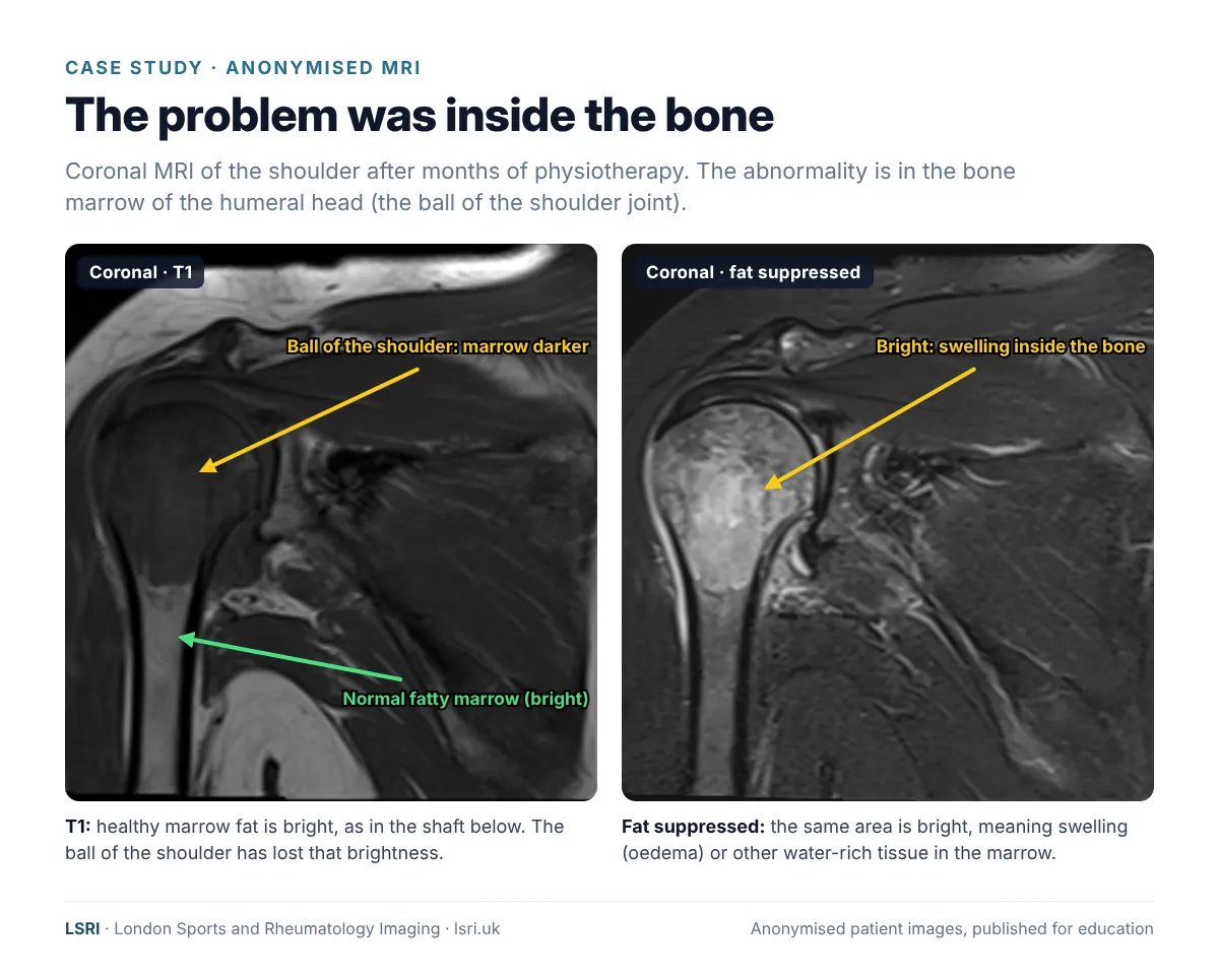 Anonymised coronal T1 and fat-suppressed shoulder MRI showing loss of normal fatty marrow signal and bright signal in the humeral head. Anonymised case from LSRI, reviewed by Dr Prashant Sankaye, Consultant MSK Radiologist