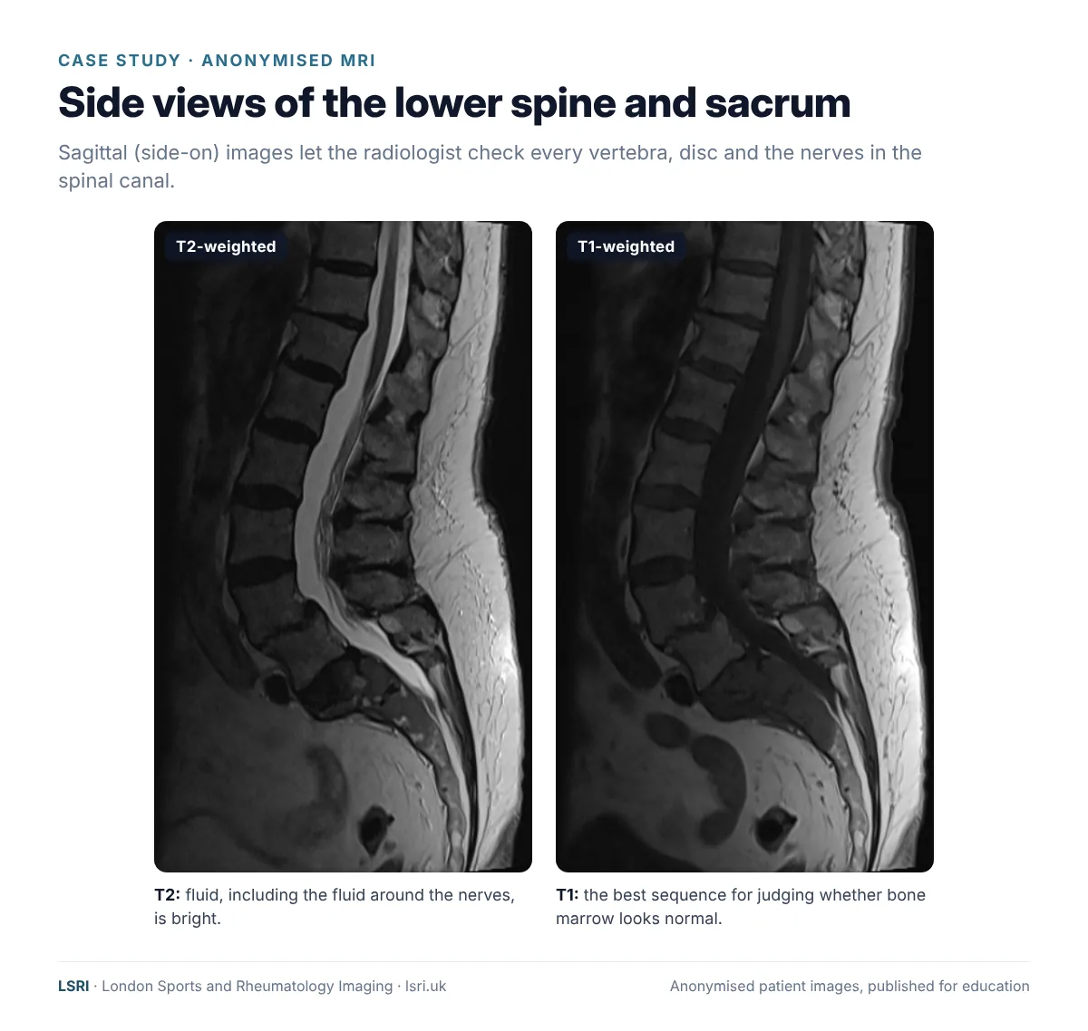 Anonymised sagittal T2 and T1 MRI of the lumbar spine and sacrum used to assess each vertebra, disc and the nerves. Reported by Dr Prashant Sankaye, Consultant MSK Radiologist, LSRI