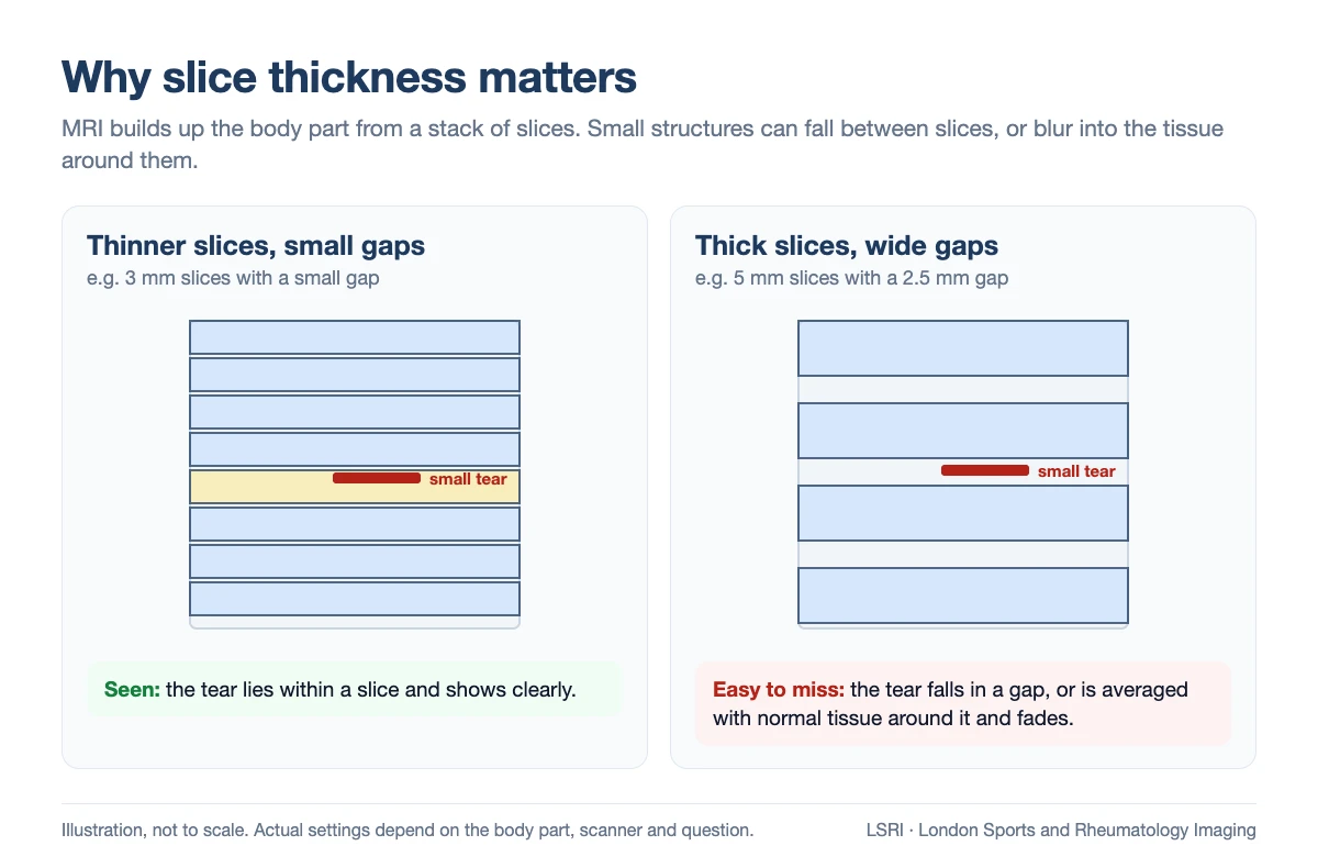 Diagram comparing thinner MRI slices with small gaps, where a small tear lies within a slice and is seen, with thick slices and wide gaps, where the tear falls between slices and is easy to miss