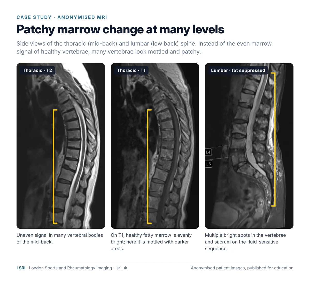 Spinal Metastases: Symptoms, Warning Signs and Why Early MRI Matters 1 Anonymised sagittal MRI of the thoracic and lumbar spine (T2, T1 and fat-suppressed) showing patchy abnormal marrow signal in many vertebrae, consistent with multiple spinal metastases. Reported by Dr Prashant Sankaye, Consultant MSK Radiologist, LSRI