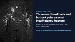 Sacral Insufficiency Fracture: A Hidden Cause of Back and Buttock Pain, and What It Says About Your Bones