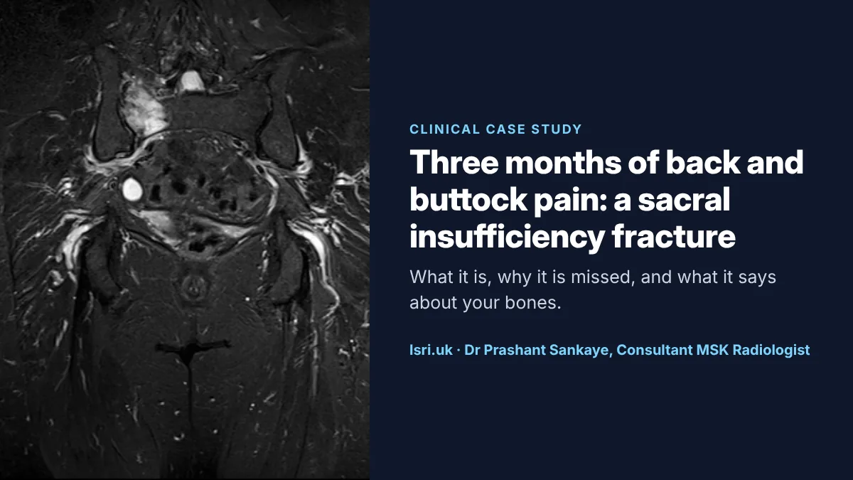 Sacral Insufficiency Fracture: A Hidden Cause of Back and Buttock Pain, and What It Says About Your Bones