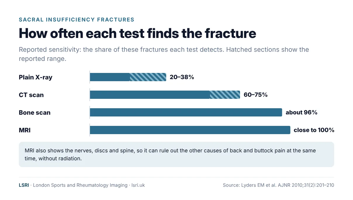 Sacral Insufficiency Fracture: A Hidden Cause of Back and Buttock Pain, and What It Says About Your Bones 2 Chart of reported sensitivity for sacral insufficiency fractures: X-ray 20 to 38%, CT 60 to 75%, bone scan about 96% and MRI close to 100%. From an LSRI guide reviewed by Dr Prashant Sankaye, Consultant MSK Radiologist