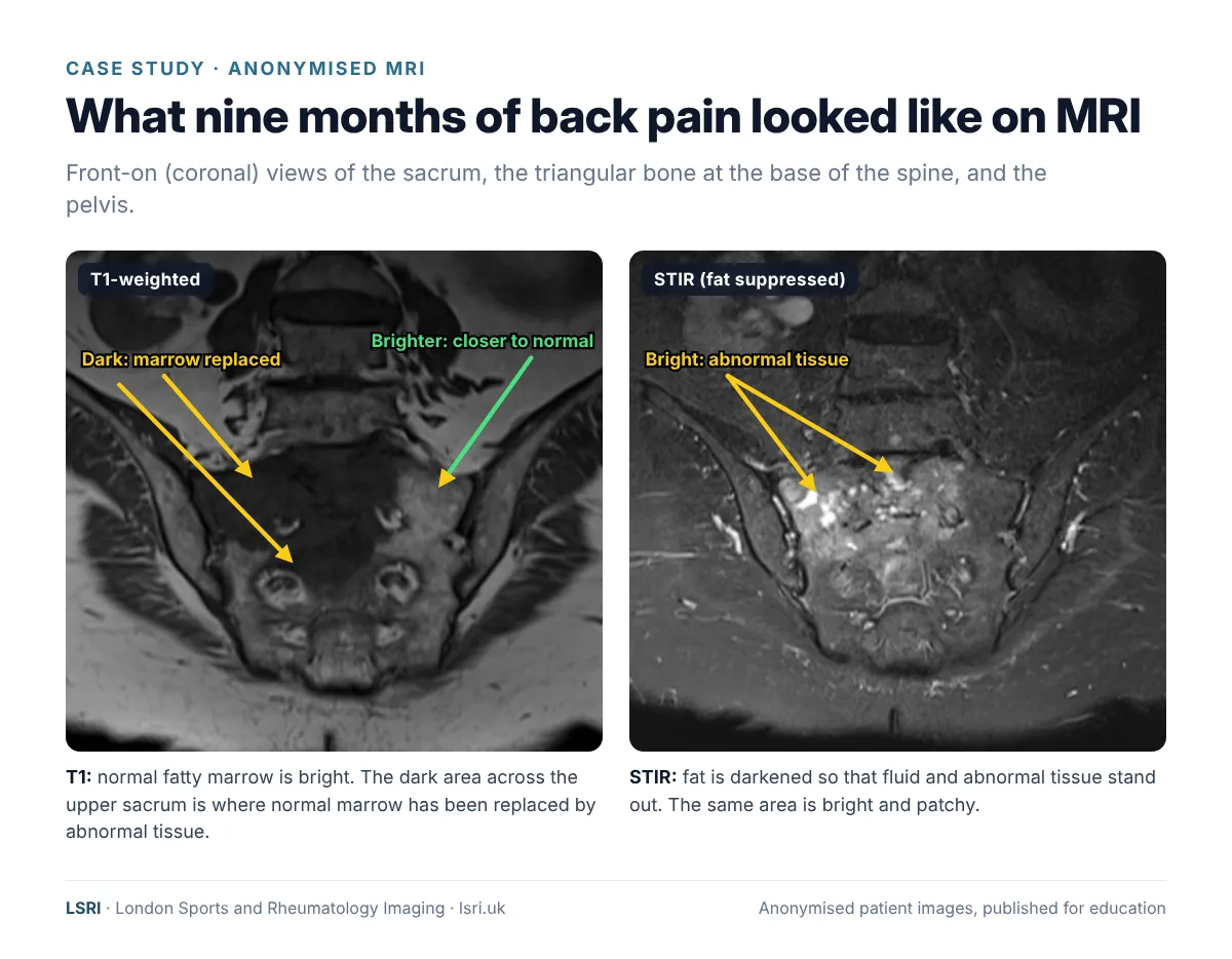 Anonymised coronal T1 and STIR MRI of the sacrum: dark marrow replacement on T1 and bright abnormal tissue on STIR, consistent with metastatic cancer. Reported by Dr Prashant Sankaye, Consultant MSK Radiologist, LSRI